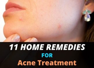 11 Home Remedies for Acne Treatment